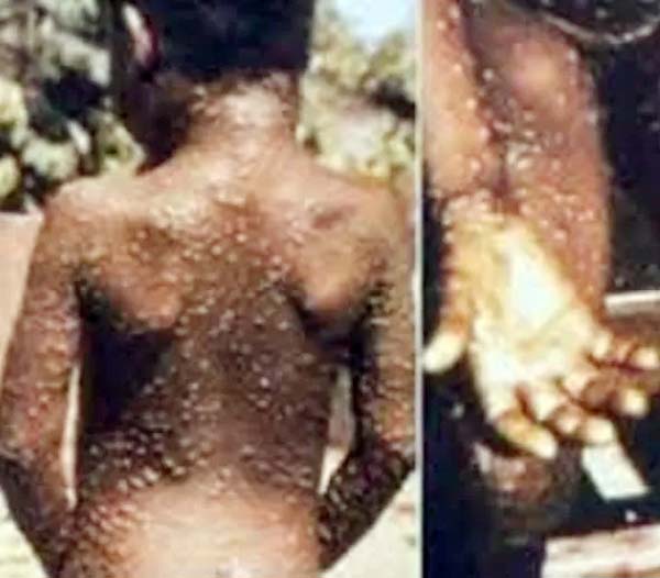 Monkeypox1