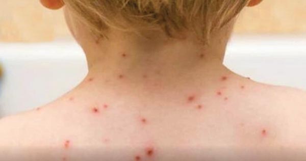 monkey pox copy