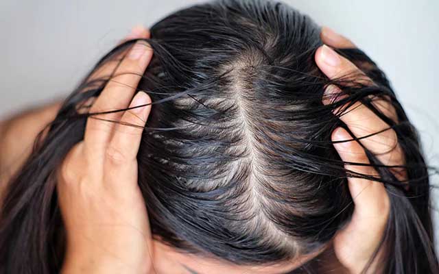 ऑयली बालों की समस्या ऑयली बालों की समस्या