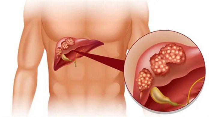 लिवर कैंसर से बचने के लिए क्या करें लिवर कैंसर से बचने के लिए क्या करें