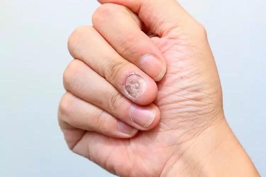 नाखूनों में फंगल इन्फेक्शन
