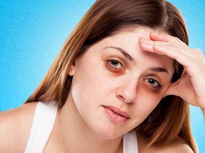 आंखों के नीचे डार्क सर्कल्स को कैसे दूर करें आंखों के नीचे डार्क सर्कल्स को कैसे दूर करें