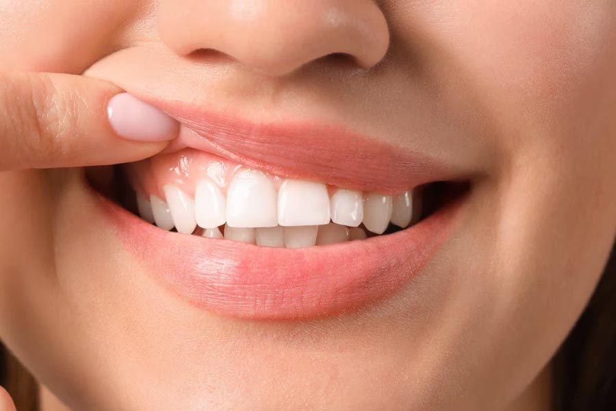 मसूड़ों की सूजन