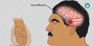 पार्किंसंस डिजीज