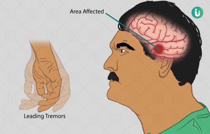 पार्किंसंस डिजीज पार्किंसंस डिजीज