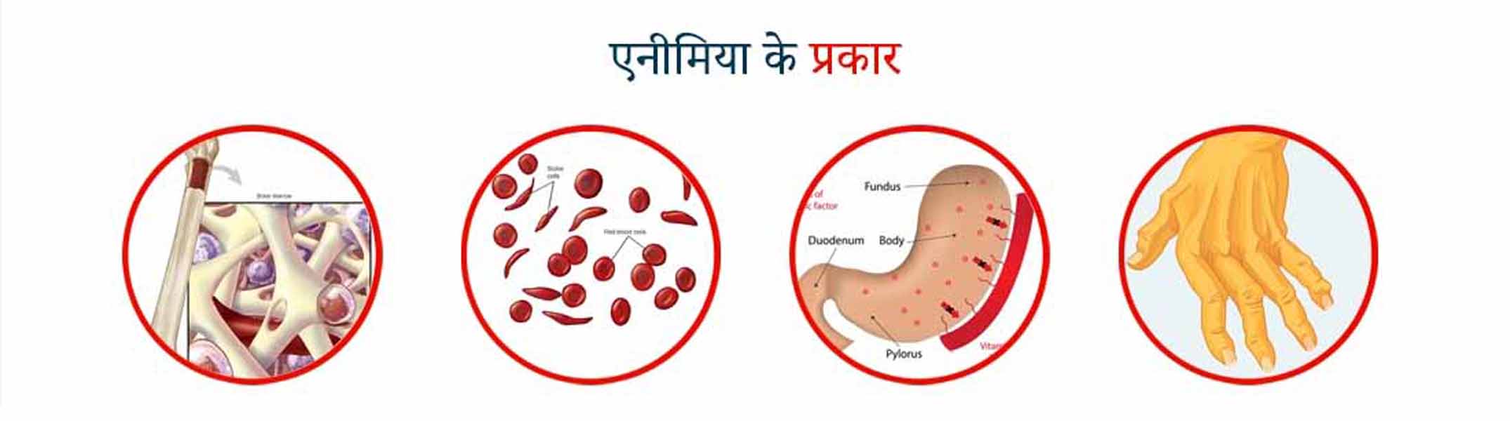 एनिमिया