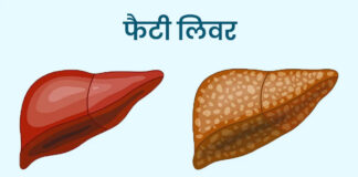 फैटी लीवर